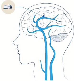 脳内の血管で血栓が詰まる脳梗塞