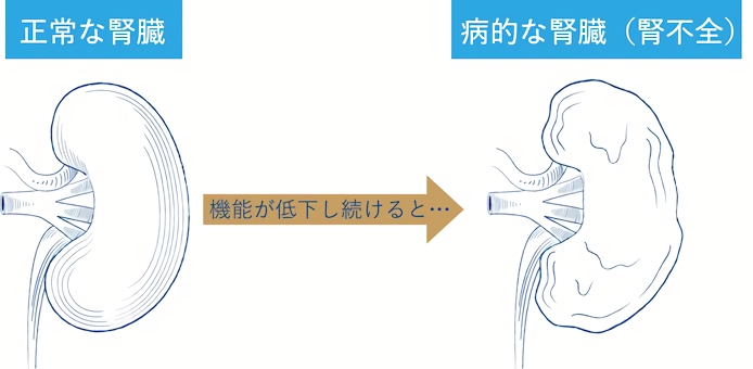 腎臓の機能が低下すると腎不全に陥る可能性がある