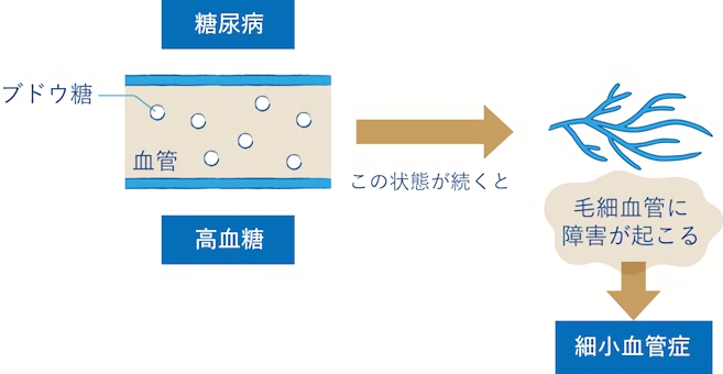 糖尿病が原因で腎臓病を引き起こす仕組み