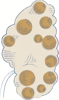 多発性嚢胞腎の状態