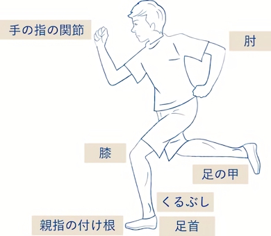 慢性関節炎は複数の関節で発作が起こる