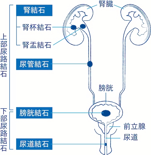 主な尿路結石の種類と発生する部位