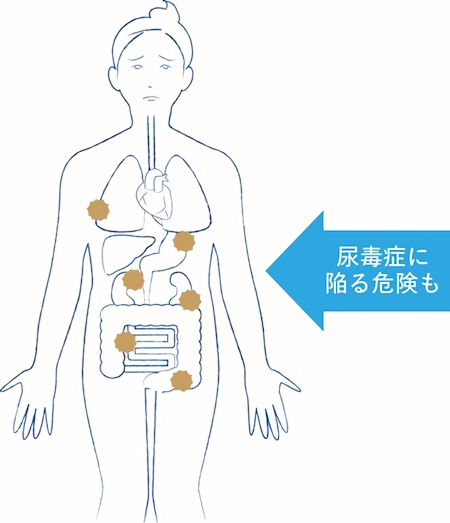 腎障害によって体内に老廃物や毒素がたまってしまう