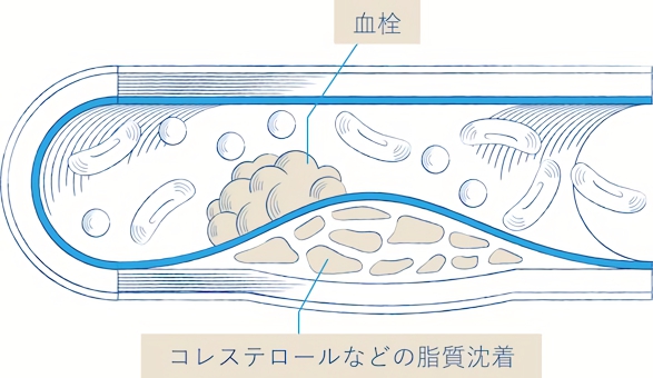 脂質異常症と診断されたら症状がなくても治療を